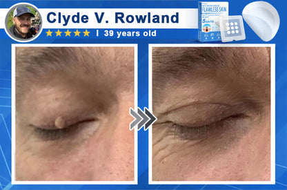👨‍⚕️ Pryxo™ 2-in-1 Microneedle & Hydrocolloid Patch | Raised Moles,Acne,  Flat Warts & Skin Tags Remover | Improves Wrinkles, Scars & Blemishes | Invisible Pimple Patches for Face & Body