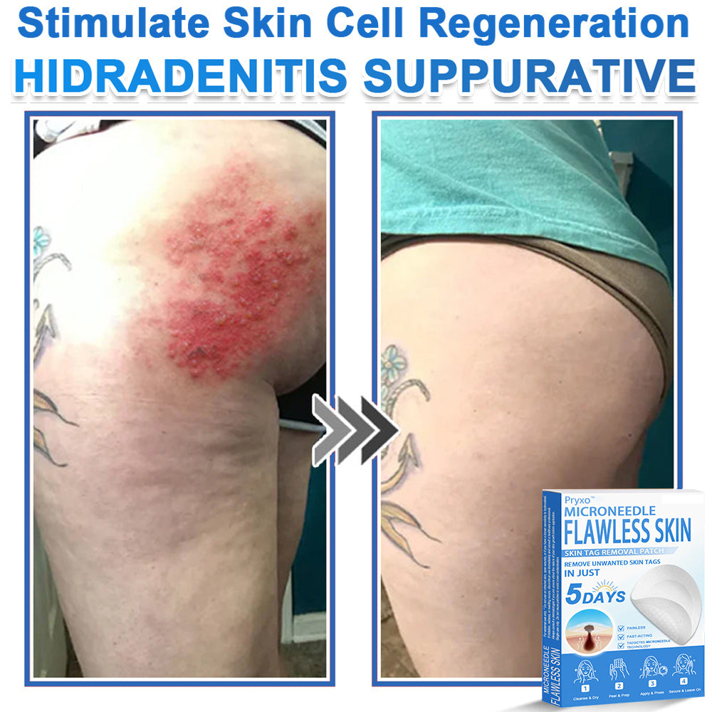 👨‍⚕️ Pryxo™ 2-in-1 Microneedle & Hydrocolloid Patch | Raised Moles,Acne,  Flat Warts & Skin Tags Remover | Improves Wrinkles, Scars & Blemishes | Invisible Pimple Patches for Face & Body